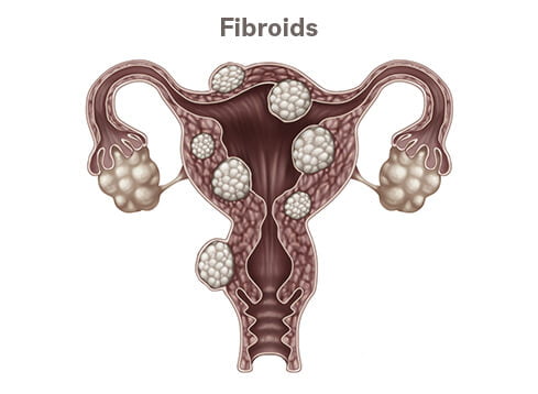 fibroids