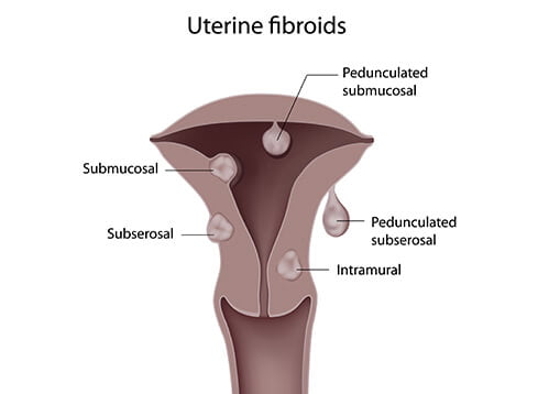 uterine fibroids