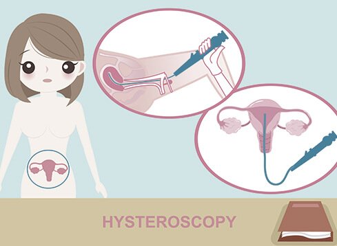 hysteroscopy