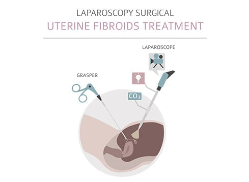 laparoscopy