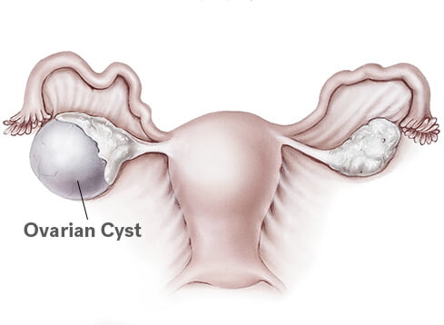 ovarian cyst