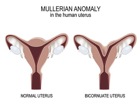 mullerian anomaly in human uterus