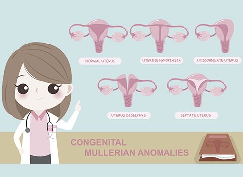 congenital mullerian anomalies