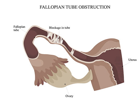 fallopian tube obstruction Matrika heritage hospital