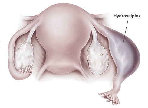 hydrosalpinx